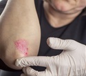 Psoriasis caused by changes in the fat metabolism of skin cells