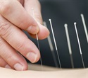 Fu's subcutaneous needling offers a safe non-pharmacological therapy for muscle-related pain