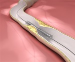 Drug eluting stents as effective as vascular brachytherapy in preventing restenosis
