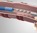 Medtronic launches GenCut Core Biopsy System for minimally invasive use with the superDimension navigation system for lung tissue biopsies