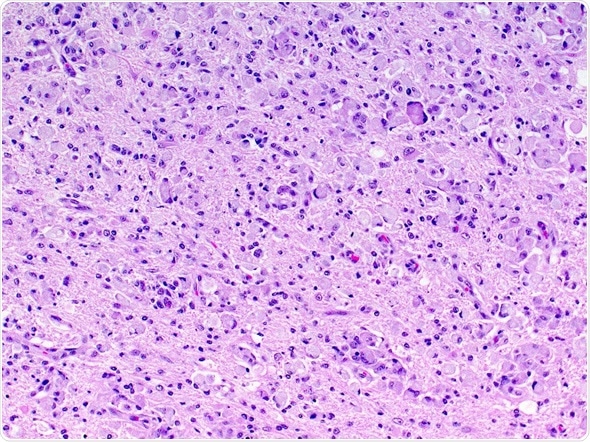 Highly magnified microscopic view showing globoid cell leukodystrophy. Neurons of the brain are distended with indigestible cellular contents resulting in neuronal dysfunction and neurological signs. Image Copyright: vetpathologist / Shutterstock Highly magnified microscopic view showing globoid cell leukodystrophy. Neurons of the brain are distended with indigestible cellular contents resulting in neuronal dysfunction and neurological signs. Image Copyright: vetpathologist / Shutterstock