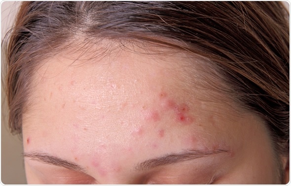 Acne on forehead. Image Copyright: TRIG / Shutterstock Acne on forehead. Image Copyright: TRIG / Shutterstock
