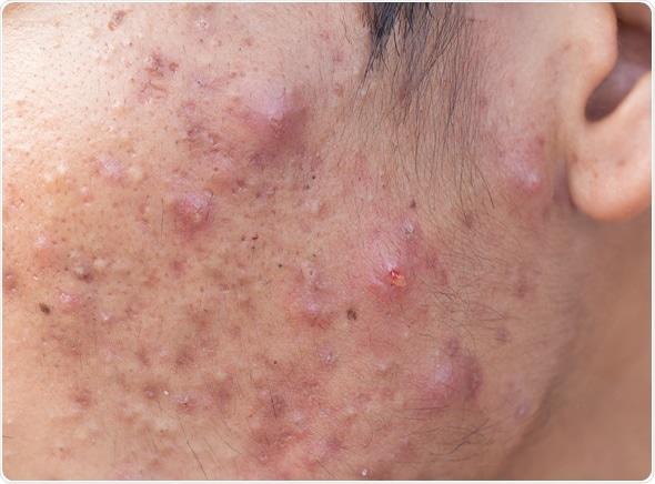 Man with problematic skin and scars from acne (scar). Image Copyright: frank60 / Shutterstock