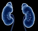 Risk of kidney stones increases higher if overweight