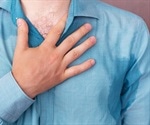 Hyperhidrosis Causes
