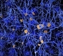 New European initiative aims to transform real world Alzheimer’s disease care