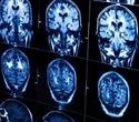 Scientists discover how stem cells navigate and repair brain damage after stroke