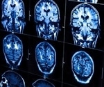 Early treatment after head injury lowers long-term risk of Alzheimer’s disease