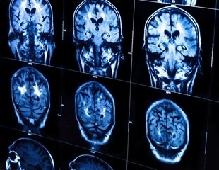 Scientists uncover promising therapeutic target for autoimmune disease affecting the brain