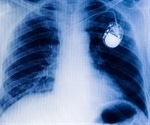 CRT implantable defibrillators significantly reduce hospitalization rates and extend lives