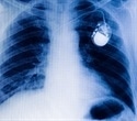 BHVH cardiologists implant investigational cardiac pacemaker the size of multivitamin