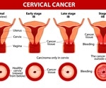 HPV and Cervical Cancer