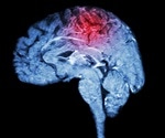 Counseling eases the depression of people caring for a loved one with the devastating brain disease