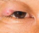 How to Treat a Stye