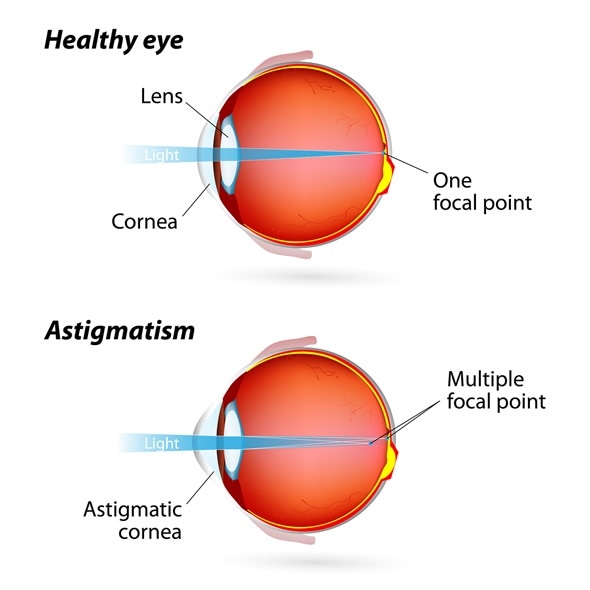 Astigmatism. Eye Condition - Image Copyright: Designua / Shutterstock