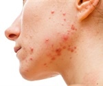 Study reveals widespread unrecognized acne among 35-year-old Finnish women