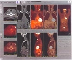 Positron Emission Tomography