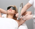 New Alma’s Soprano laser technology delivers painless procedure for hair removal