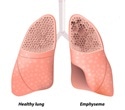 Improving COPD care by enhancing communication and education