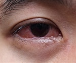 Symptoms and Diagnosis of Eye Allergies­­