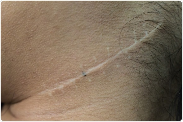 Scar from operation on neck - Image Credit: Ratchaya Nonthanaphat / Shutterstock Scar from operation on neck - Image Credit: Ratchaya Nonthanaphat / Shutterstock