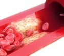 Immune cell energy metabolism shapes the progression of atherosclerosis