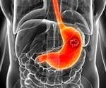 EHR-embedded AI tool can identify patients at risk for esophageal and stomach cancer