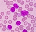 Fixed-duration therapy works as effectively as continuous treatment for chronic lymphocytic leukemia