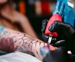 AlexTriVantage pigment-specific lasers for multi-colored tattoo removal