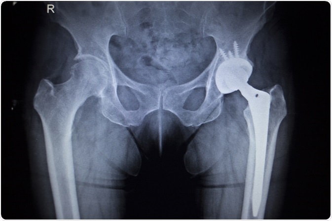 x-ray of a hip replacement
