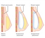 Breast Surgery