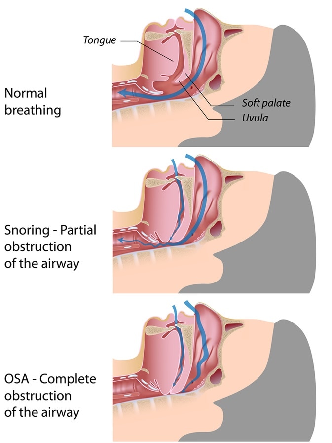 Obstructive Sleep Apnea - Image Credit: Alila Medical Media / Shutterstock
