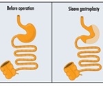 Complications of Sleeve Gastrectomy