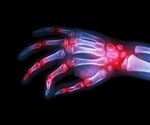 Nanoparticles could slow rheumatoid arthritis progression and reduce flare severity