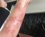 Atomic Kitten Natasha Hamilton leads 'black henna' temporary tattoo warning