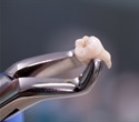 Over-the-counter pain relievers outperform opioids after wisdom tooth extraction