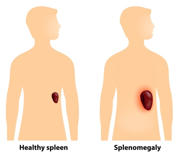 Splenomegaly is an enlargement of the spleen. Image Credit: Designua  / Shutterstock