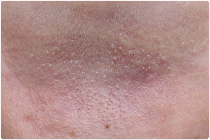 Prickly heat on the skin - Image Credit: charnsitr / Shutterstock