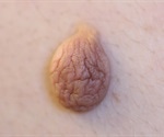Genital Wart Symptoms
