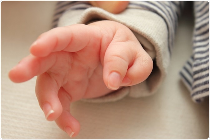 Polydactyly, Congenital. Image Credit: By v.gi / Shutterstock