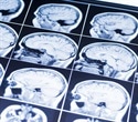 Simple drug treatments could help older brains cope with memory decline and postoperative recovery