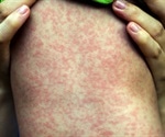 Measles outbreak - 35 reported deaths in Europe
