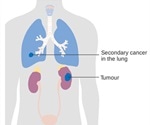 Secondary Lung Cancer