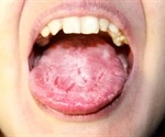 Oral Candidiasis (Oral Thrush)