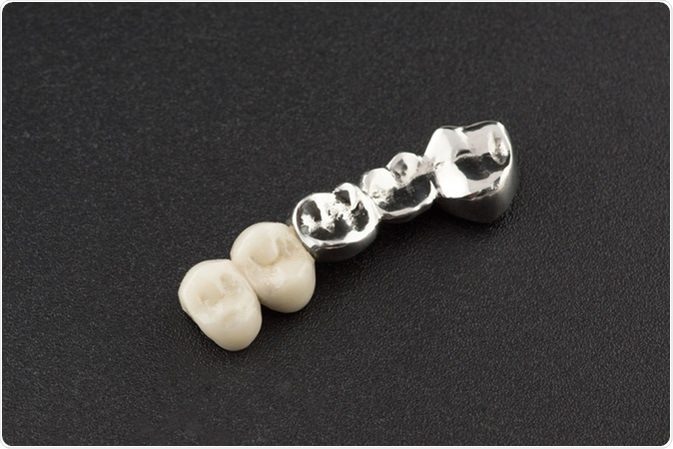 Bridged dental prostheses are made of steel and ceramic paste. Image Credit: Krezodent / Shutterstock