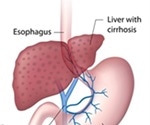 Esophageal Varices