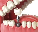 Dental Implant Techniques