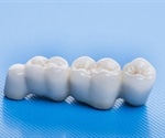 Care for Dental Bridges