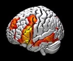Study investigates how brain lesion affects child’s language localization and abilities