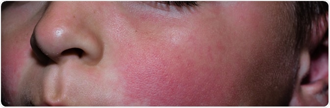 The rash from fifth disease on a child. Image Credit: Weakiva / Shutterstock